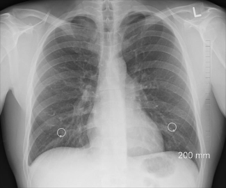 xray of lungs